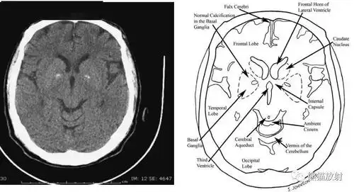 颅脑ct的正常解剖