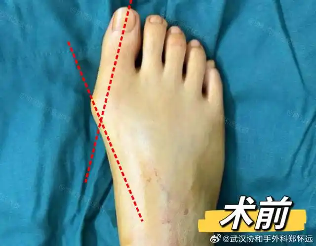 在最近的问诊中,经常有些刚做完拇外翻手术的患者会询问我:"郑