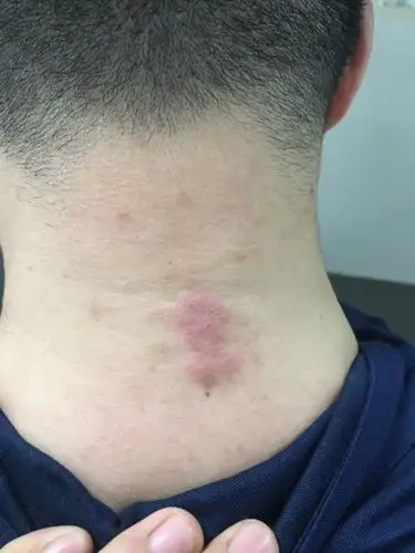 脖子后面起了一块皮疹,有一个星期了,还有痒,挠起来痛,是过敏性皮炎