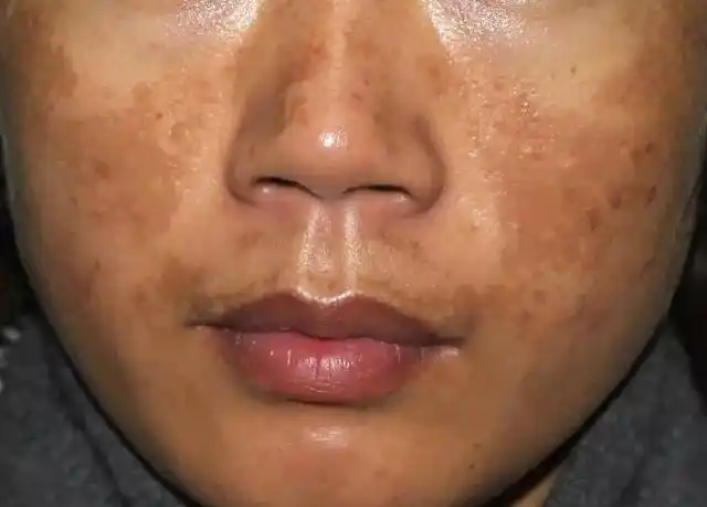 在这重点说说皮肤屏障功能不建全对黄褐斑的影响,这个致病原因,占到