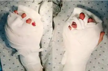 22小时奋战,南医大南海医院为伤者"断指再植"创失而复得奇迹!