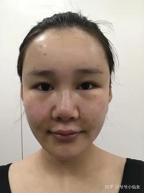 全脸脂肪胶填充效果怎么样呢? - 知乎