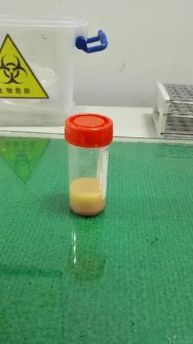 最近看到关于乳糜试验的讨论,现公布一组胸水乳糜试验图片,请大家发表