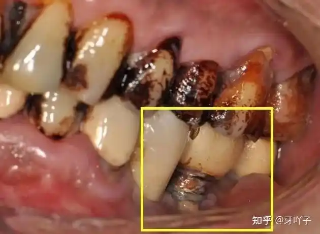 种植牙寿命大揭秘.