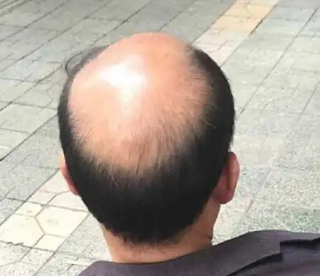 为什么秃顶的人,宁愿周围留一圈头发,也不愿意剃光头?