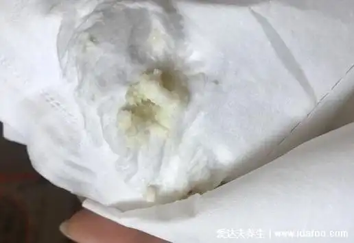 图中就是典型的念珠菌性阴炎(霉菌性花园炎)的症状,因为感染了念珠菌