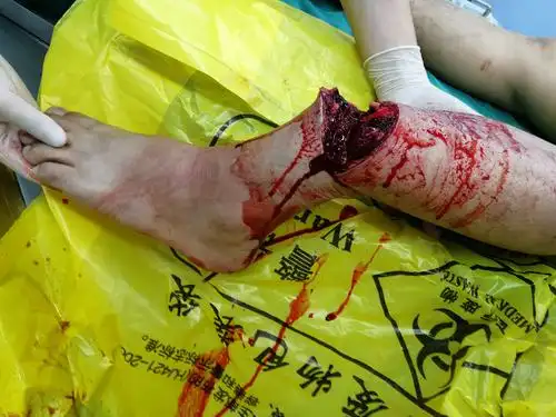 急诊救治多肢体离断