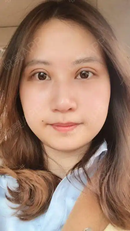 全切双眼皮术后7天_双眼皮术后7天_眼部整形术后7天_悦mer_5048533177