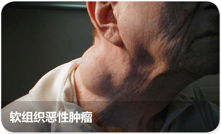 肿瘤科疾病—软组织恶性肿瘤(肉瘤)