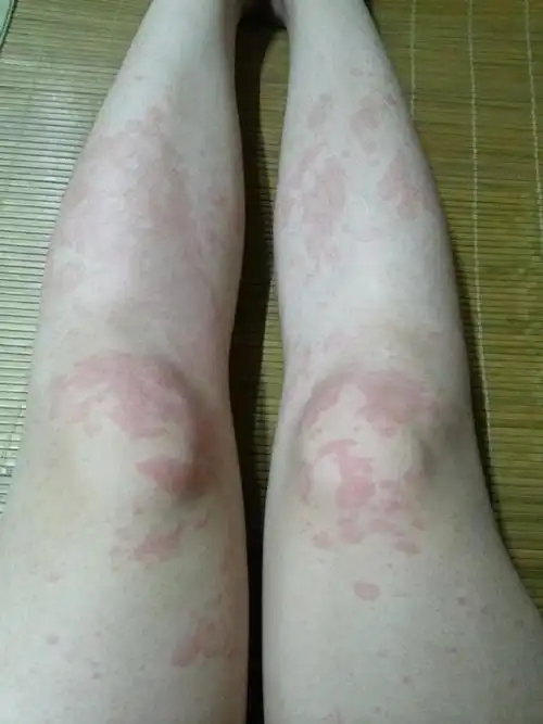 怎样辨别荨麻疹还是湿疹