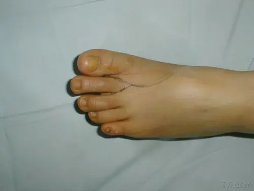 第二足趾再造环指 - 骨科与显微外科专业讨论版 - 爱爱医医学论坛