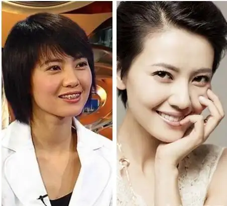 全民女神高圆圆做牙齿矫正对比图,明星牙齿矫正,高圆圆做牙齿矫正