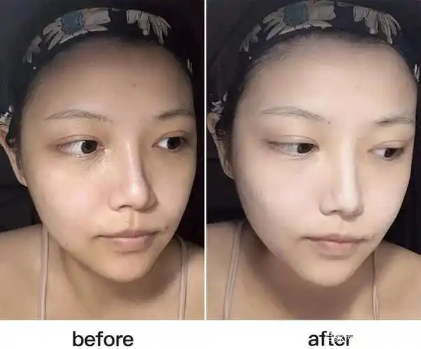 收缩毛孔选择什么医美项目毛孔粗大必看