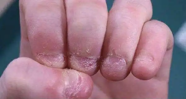 5岁儿子总咬指甲妈妈斥责却没用如何帮孩子纠正这个坏毛病