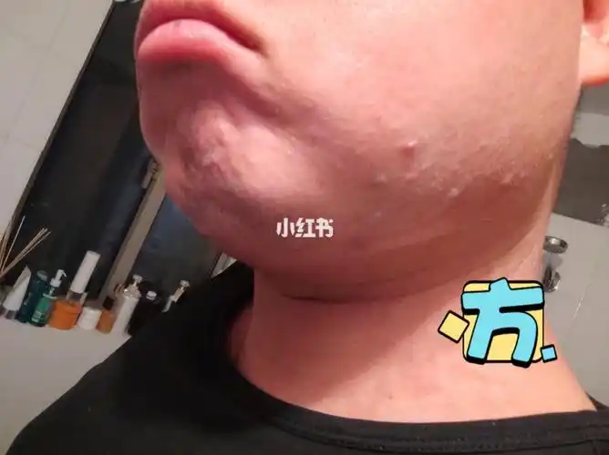 过敏体质还去吃的下场