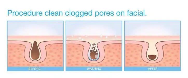 黑头清洁程序清洁堵塞毛孔脸部照片