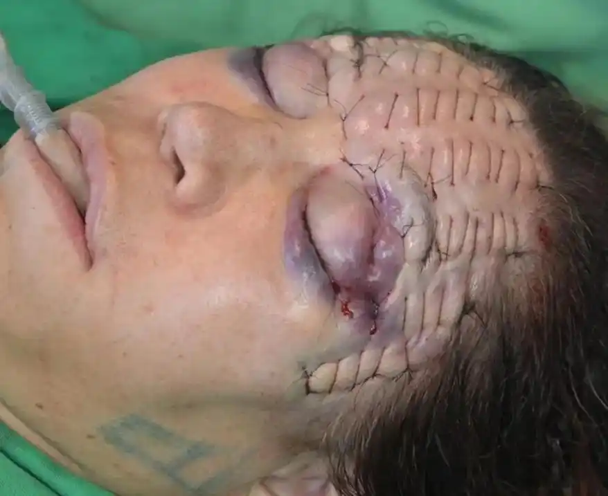 我不懂,但是大为震惊!听说这是一种小切口的额头拉皮术,用剥 - 抖音