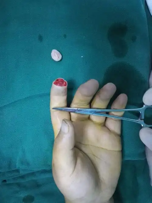 患者左手食指末节指尖断裂.
