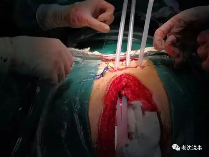 上图中三根引流管一头分别放在胸腔的不同位置手术后的几天体内渗出的