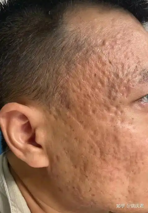 [治疗反馈] 20多年的重度痘坑治疗经过