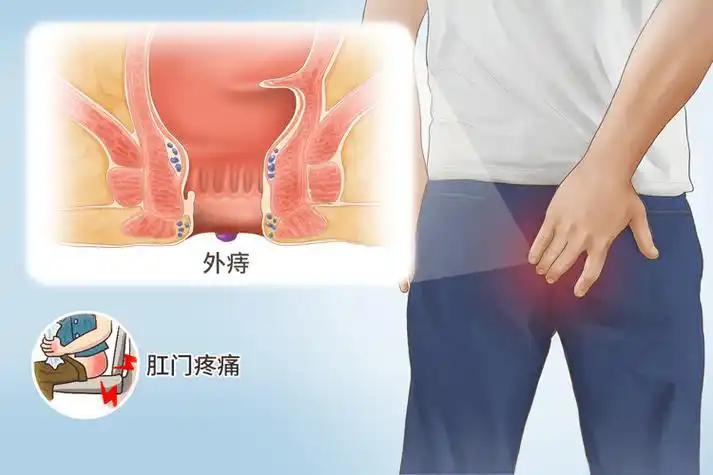 医生:肛门若常有4种不适,警惕癌症在靠近_接种_症状_风险