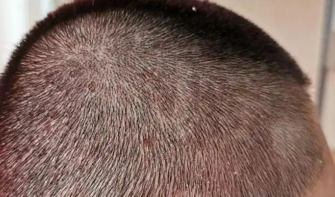 如何判断是不是脂溢性皮炎(如何判断是不是脂溢性皮炎脱发)