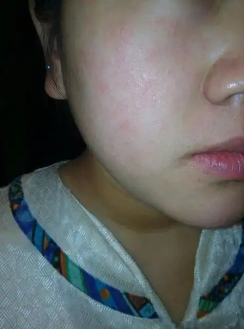 大人肠胃过敏体质症状(肠胃过敏怎么调理)