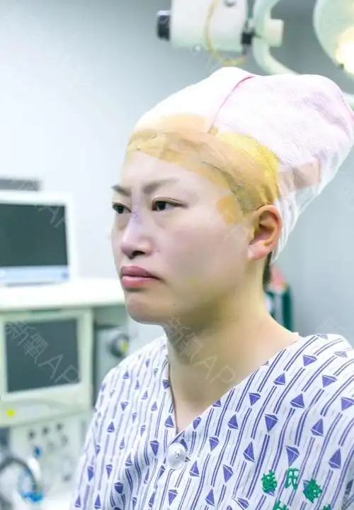 三亚驼峰鼻矫正好不好_效果图_氧气a3s73de驼峰鼻矫正术后第1天_新氧