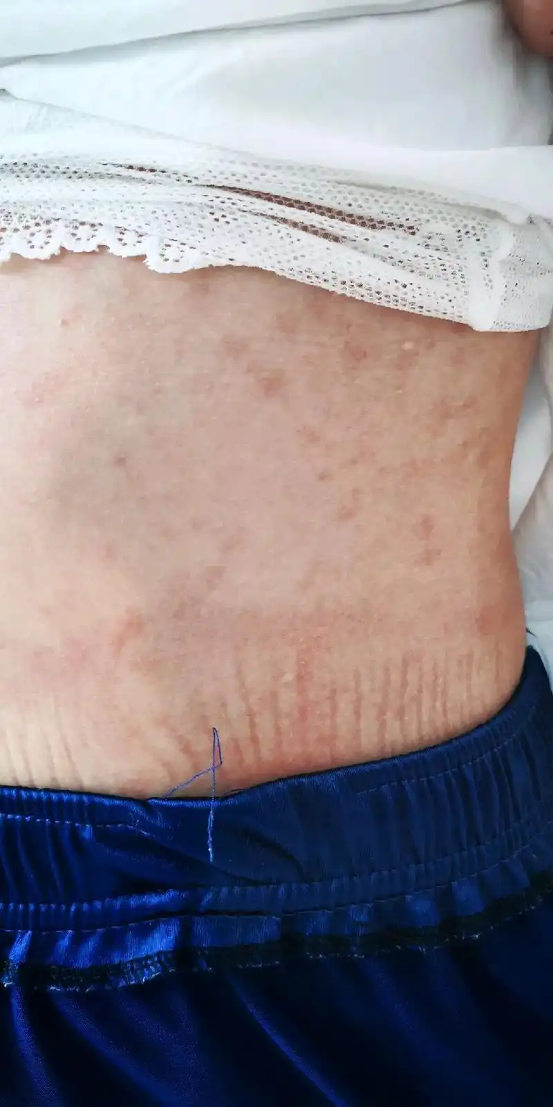 大家听到xing病第一个想到的什么呢?很多人会说梅毒,觉得得 - 抖音