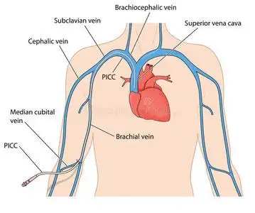 导管外周插入的中央导管照片