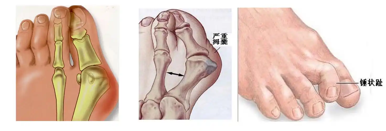 拇外翻大脚骨
