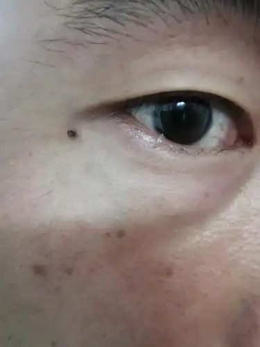 最近眼睛下眼皮有个小疙瘩,有懂的人帮我解答一下吗?