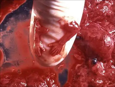 5) 早期堕胎:11周大的胎儿 向左转  向右转