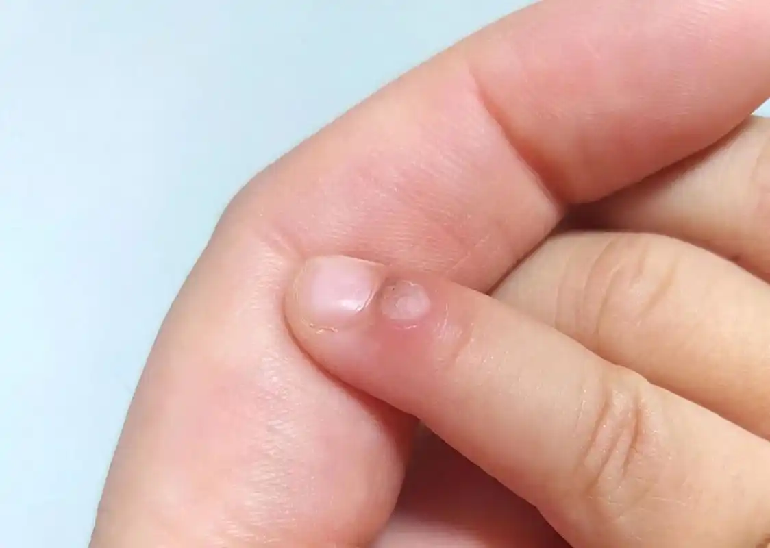 芝麻花偏方治疣(试验中)闺女手指头上的疣 跟朋友吃饭,谈到了女儿手指