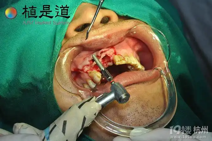 种植牙过程介绍(图2)