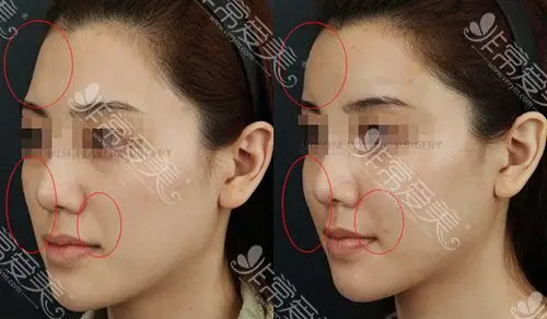 promis面部脂肪填充前后对比