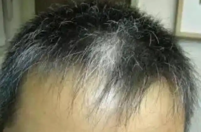 人活到了一定的年纪,就会有白头发,这是一个很自然也很正常的生理现象