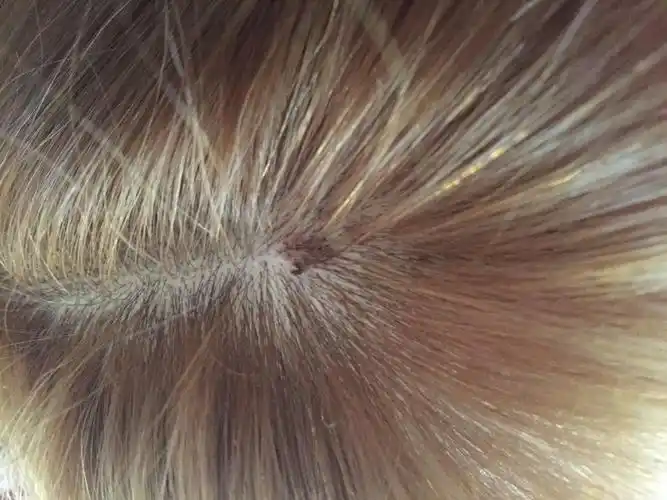 我2天连续染了3次头发,完了之后头皮起了一块黑色的痂是怎么回