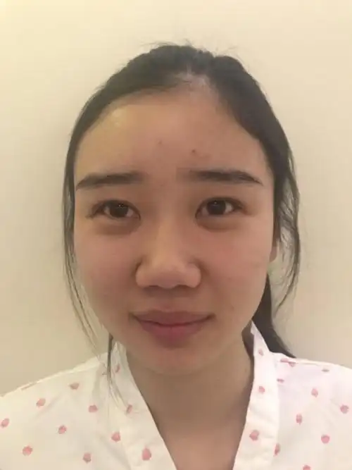 我我的鼻子在没做之前是非常难看的比量,他鼻子扁平显_圈子-新氧美容