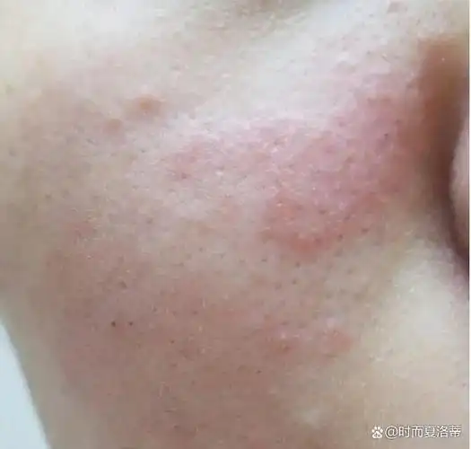 甚至导致后续是的数次化妆品过敏的情况.