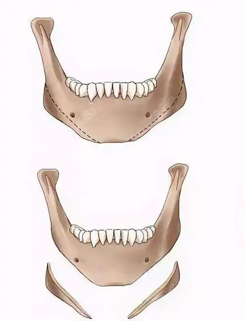 广州罗延平价格挖到,下颌角磨骨整形9970元起好低啊,颌面对比照-8682