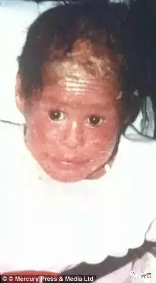 女子患鱼鳞病像蛇一样脱皮,一年掉80斤皮!