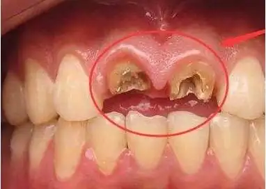 烂牙根为什么定6767不少人因为蛀牙,或者外伤导致的好好的牙齿坏