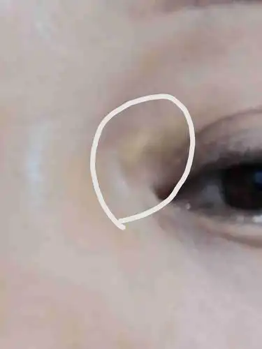 这个长眼角的是什么啊?不会湿白癜风吧