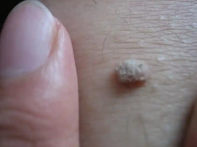 寻常疣图片初期图片