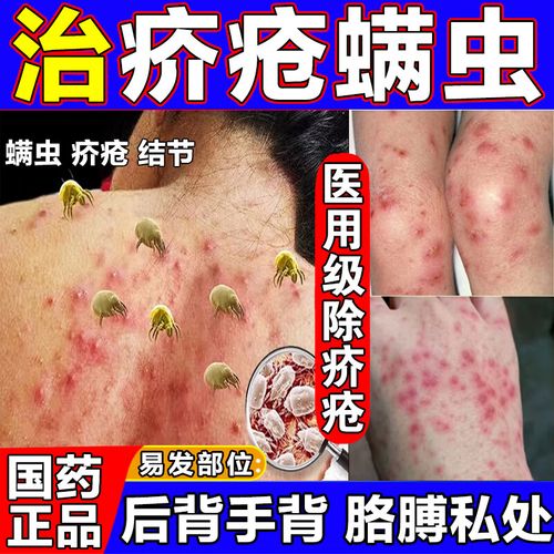 硫软膏20g软膏疥疮专用药膏 阴虱螨虫疥虫感染阴囊皮肤溃烂瘙痒小疙瘩