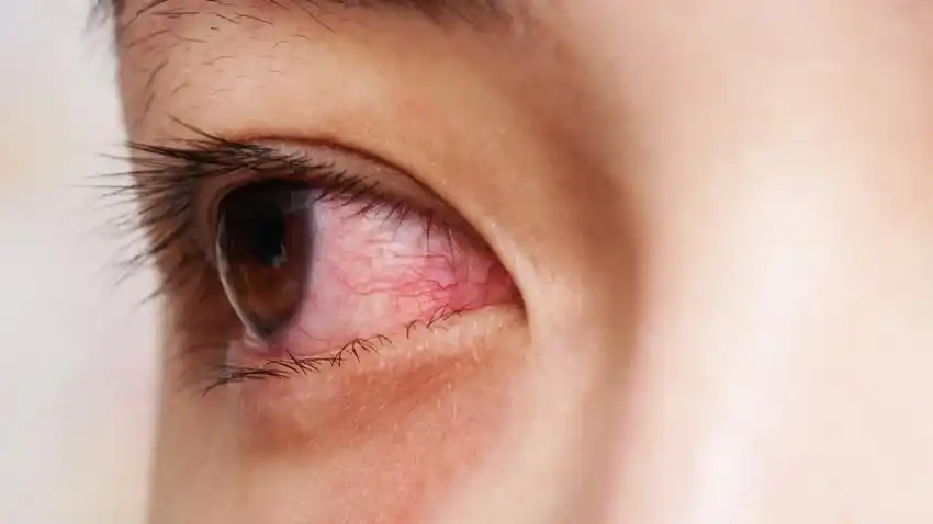 眼睛干涩,头发枯黄,女性容易血虚,8大症状你中几项?