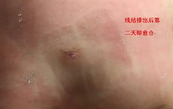 术后应该注意伤口清洁消毒,未痊愈时注意避免污染,刺激伤口,3月内避免