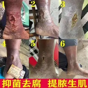 脉管溃炎老烂腿外用去腐生肌膏糖尿足病静脉腐烂腿膏烂脚伤口愈合