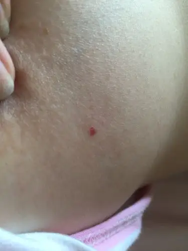 最近发现乳房上有个红色点点,有点点像红痣,不痛不痒的,以前宝宝吃